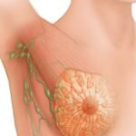 wie sieht brustkrebs aus bilder