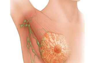 wie sieht brustkrebs aus bilder