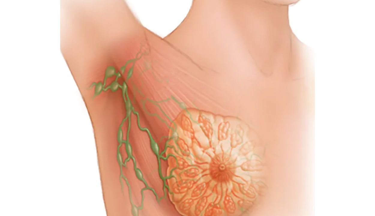 wie sieht brustkrebs aus bilder